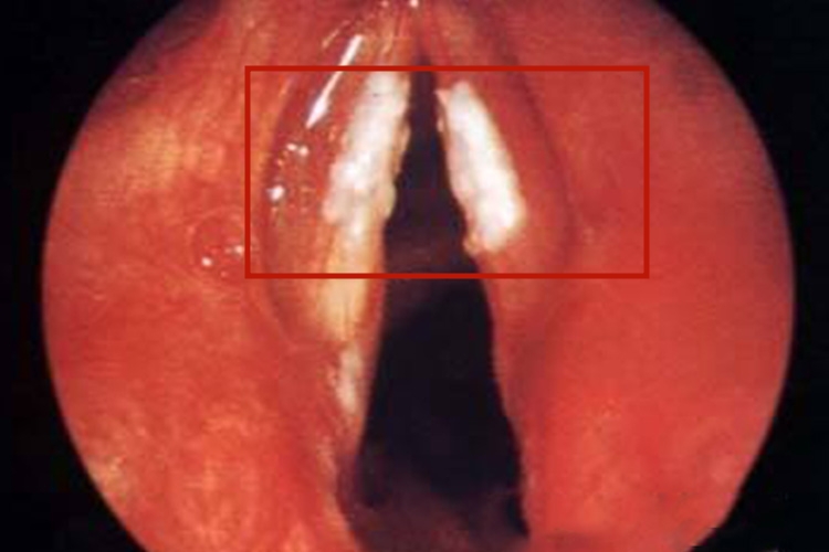 喉镜暗红色梭形声带黏膜图