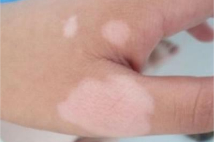 白癜风手背症状图 白癜风手背症状图