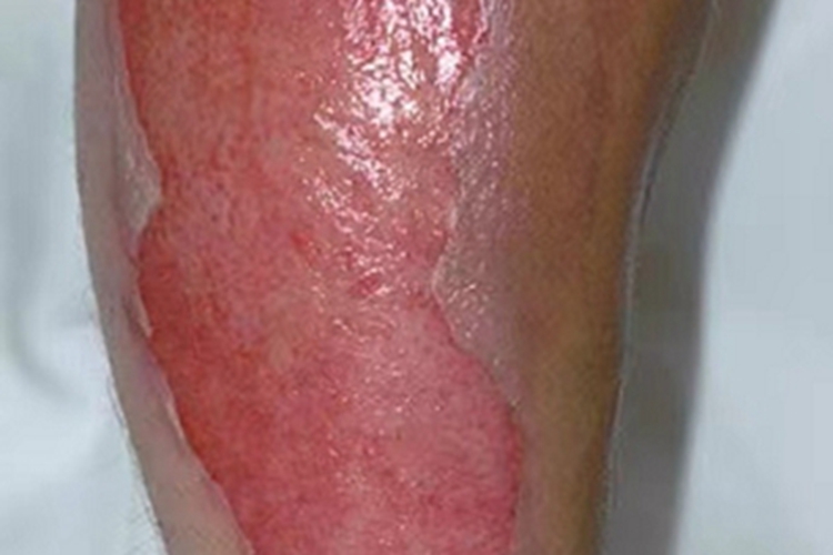 深Ⅱ度烧伤大腿脱皮图