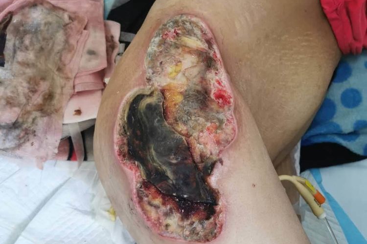 臀部急性蜂窝组织炎皮肤坏死图