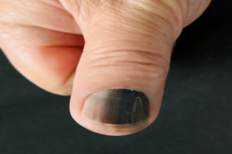 黑色素瘤图 黑色素瘤图