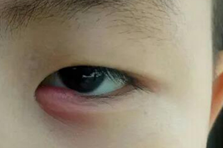 外睑腺炎下眼睑红肿图