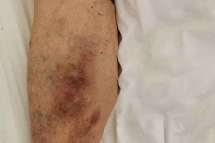 隐静脉曲张小腿皮肤暗红图