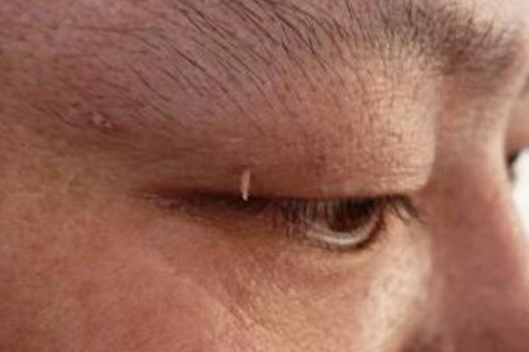眼睑丝状疣图片 眼睑丝状疣图片