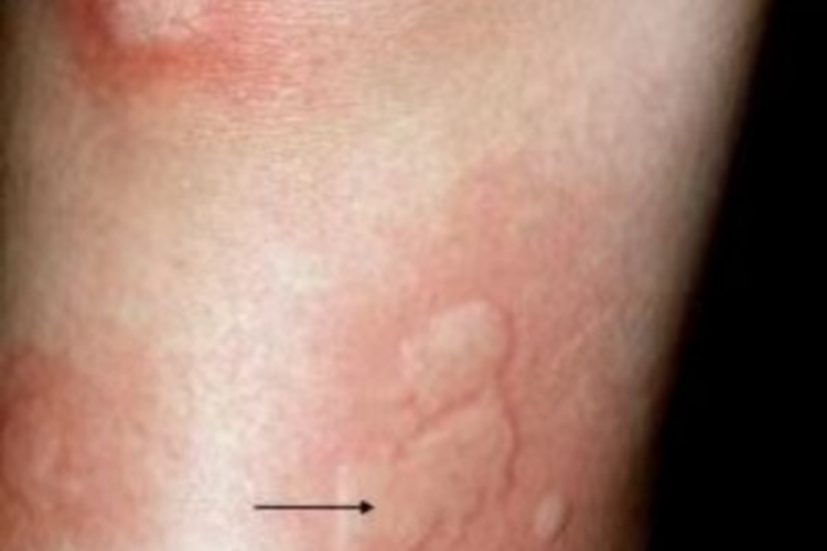 急性自发性荨麻疹腿风团图 急性自发性荨麻疹腿风团图