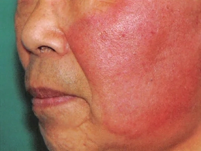 急性网状淋巴管炎可见患者面部有一片红肿,呈水肿性鲜红斑片,皮肤隆起