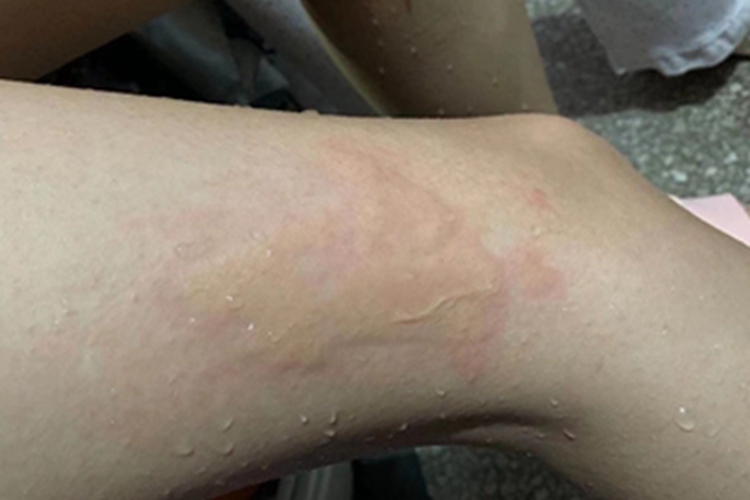 二度烫伤大腿水肿图