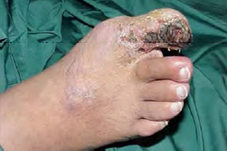 闭塞性动脉硬化症脚趾增厚图 闭塞性动脉硬化症脚趾增厚图