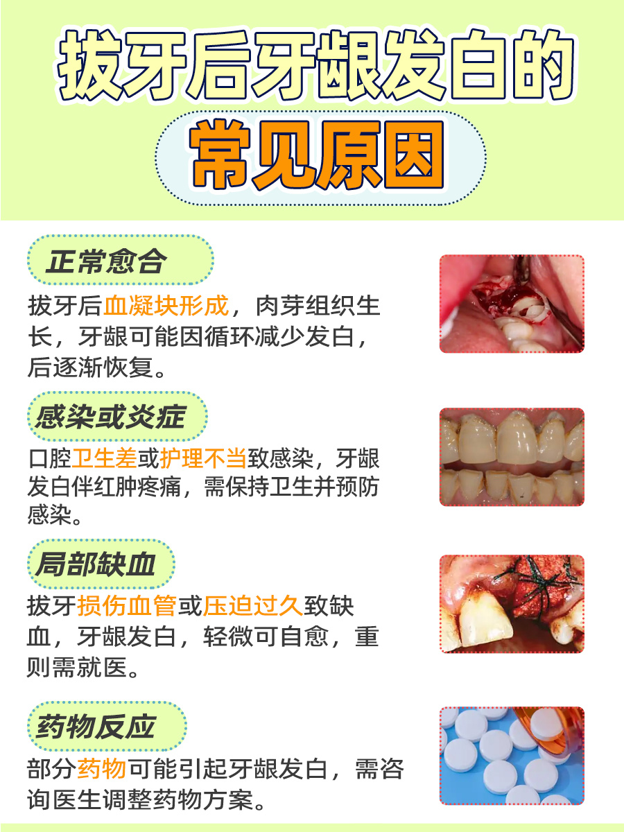 不可忽视！拔牙后牙龈发白的几种可能情况