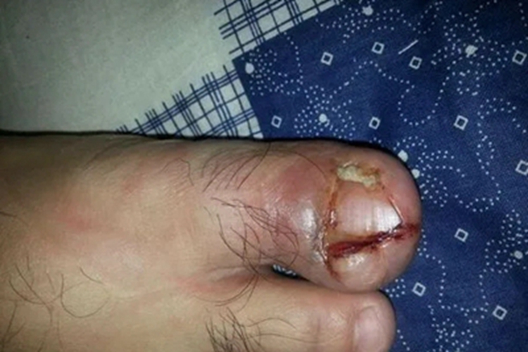 急性甲沟炎脚趾甲烂了有脓图