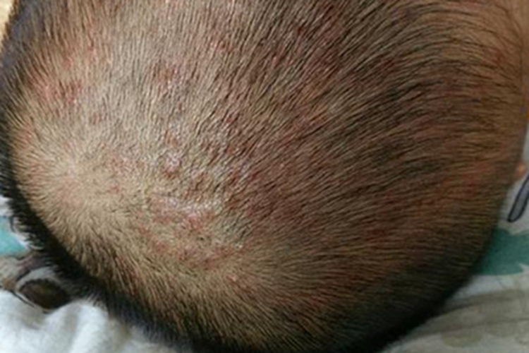 毛囊炎头皮上好多小红疙瘩图