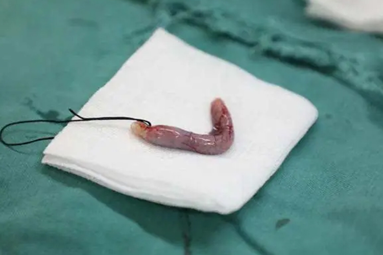 切除的阑尾图