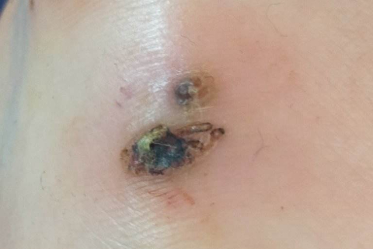 跖疣激光治疗后正常结痂图 跖疣激光治疗后正常结痂图