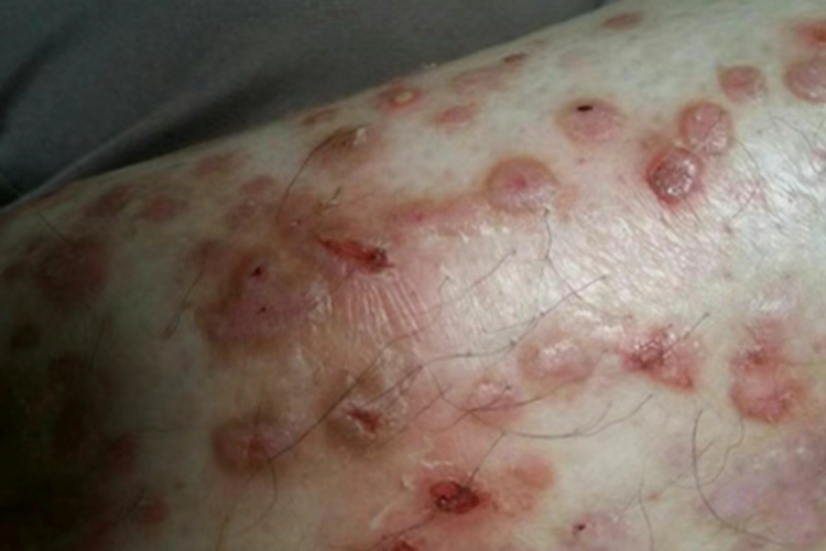 单纯性痒疹腿疙瘩图
