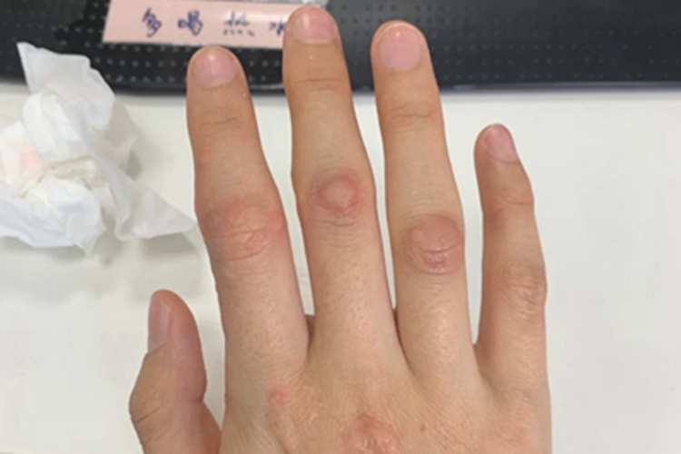 皮肤过敏红肿手指水疱图 皮肤过敏红肿手指水疱图