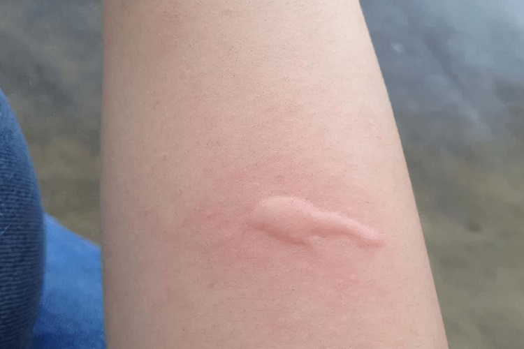 蚊子咬所致丘疹性荨麻疹图