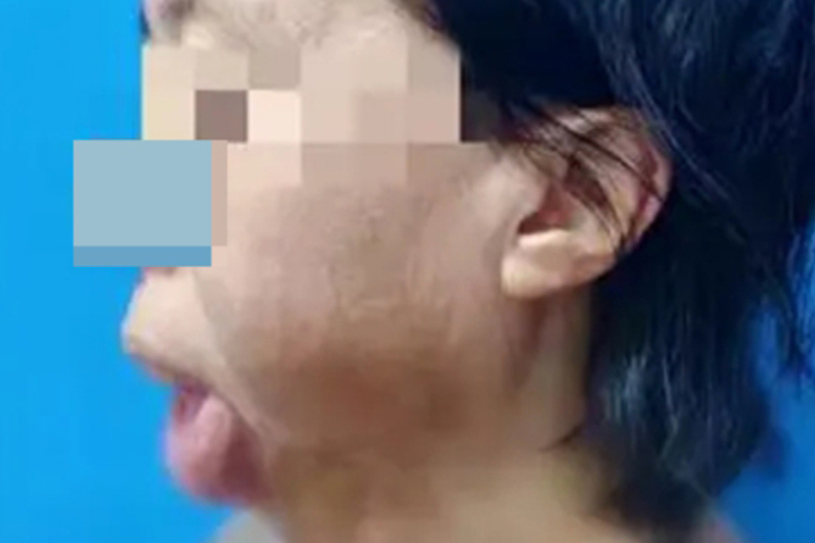 嘴唇严重外翻侧面图