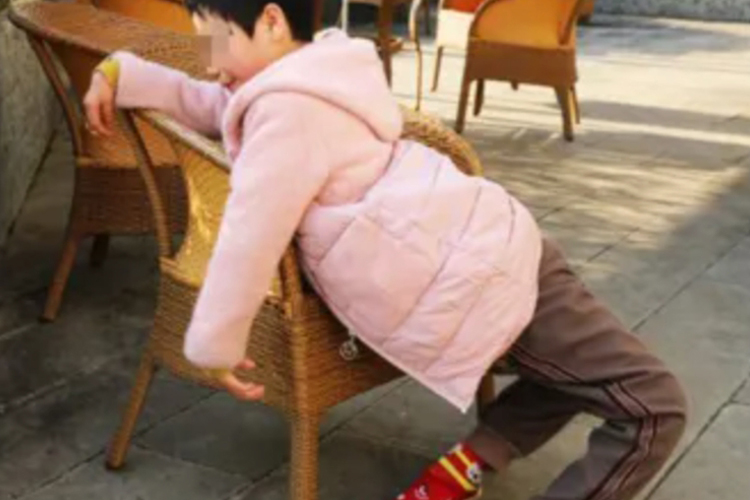 双侧膝反曲畸形图 双侧膝反曲畸形图