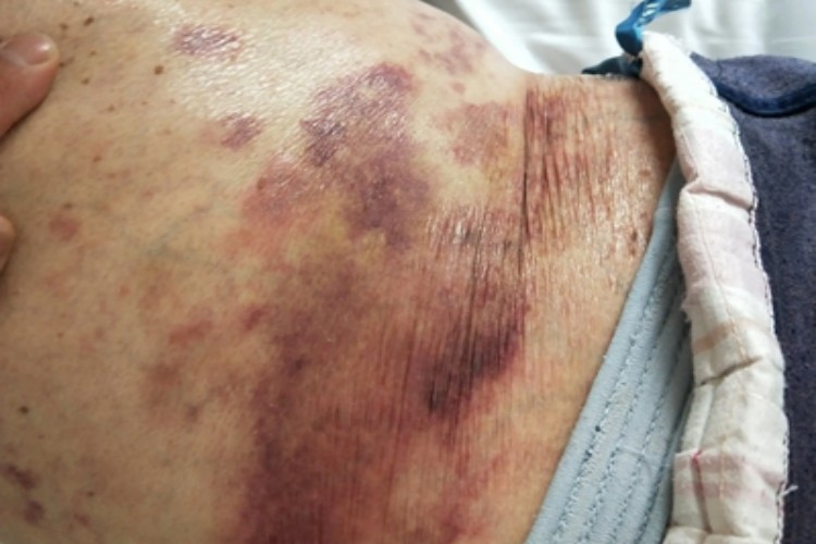 血管内压力增多性紫癜腹部症状图