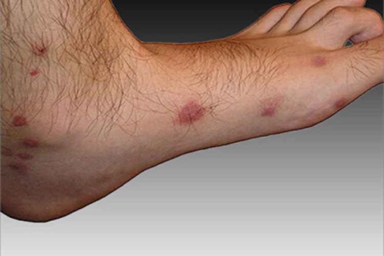 登革热脚部红斑图