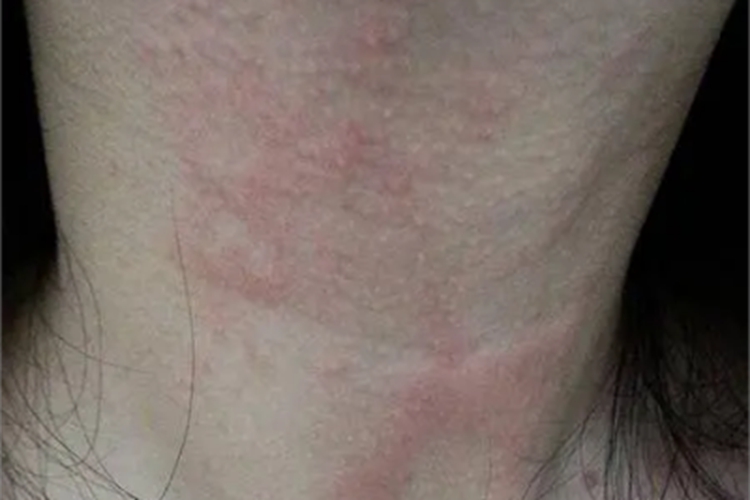荨麻疹型药疹前颈红斑图