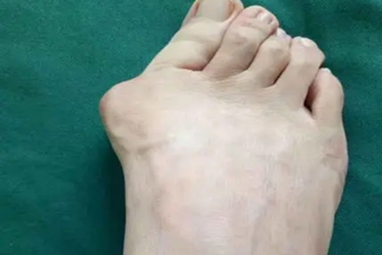 拇外翻大脚趾畸形图