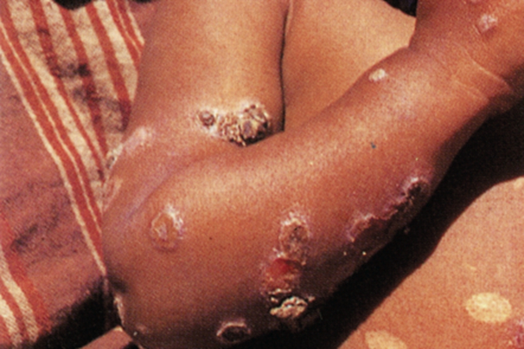 女性三期梅毒胳膊症状图