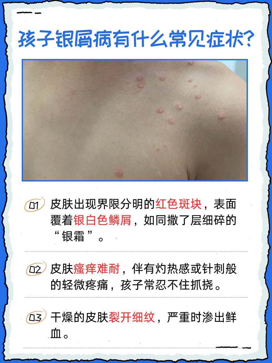 孩子银屑病是什么病，能治愈吗｜家长必看