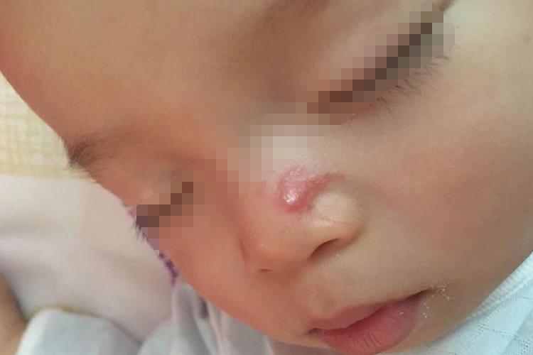 脸上长疖图 脸上长疖图