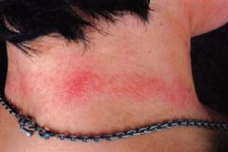 脖颈部位接触性皮炎图