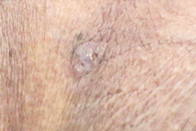 单发型表皮松解性棘皮瘤疙瘩图