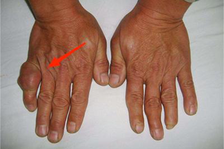 腱鞘巨细胞瘤硬疙瘩图