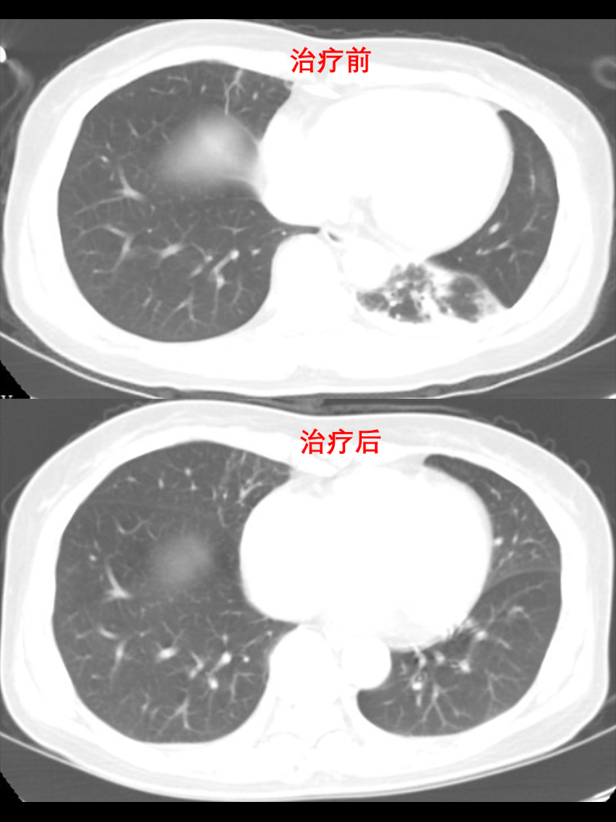 治疗前后胸部CT对比.jpg