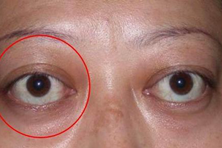 高度近视眼球突出图