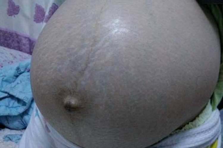 孕妇肚脐眼凸起图