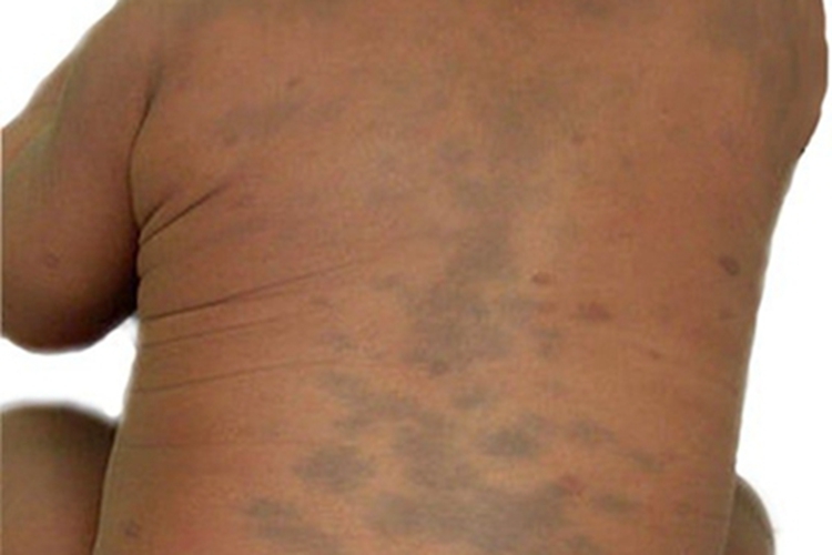 伊藤痣后背多发青色斑块图