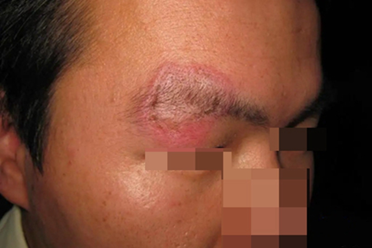 离心性环形红斑症状图