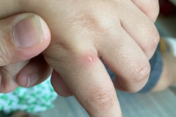水痘手部小水疱图 水痘手部小水疱图