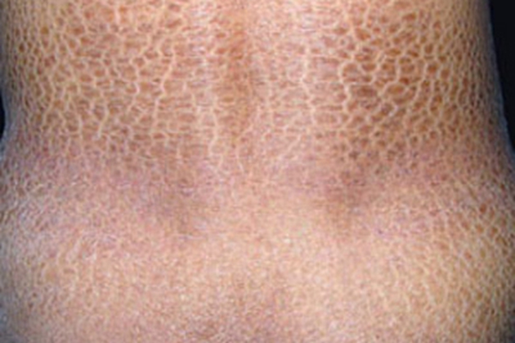 非大疱性鱼鳞病样红皮病皲裂图 非大疱性鱼鳞病样红皮病皲裂图