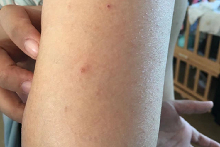 传染性软疣结痂图