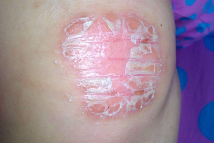 银屑病关节炎膝盖脱屑图 银屑病关节炎膝盖脱屑图