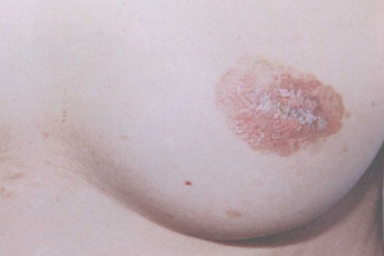 乳房Paget病红斑图