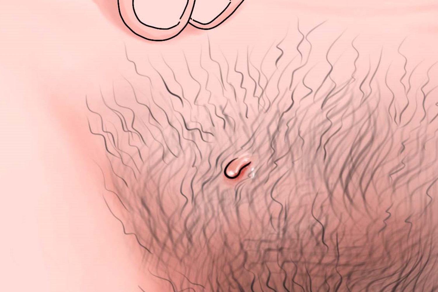 软纤维瘤外阴小揪揪手绘图 软纤维瘤外阴小揪揪手绘图