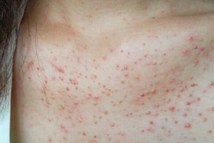 青年成人期特应性皮炎胸部丘疹图