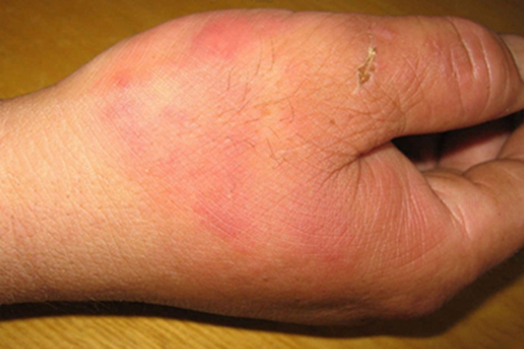 局限型类丹毒手部症状图