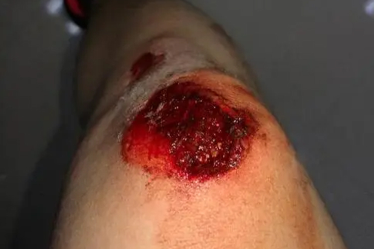 腿部开放性创伤图