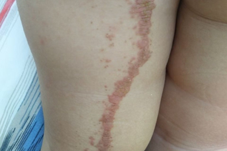 线状苔藓大腿症状图 线状苔藓大腿症状图