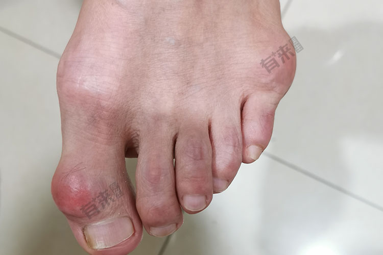 第一跖趾关节处的痛风石图