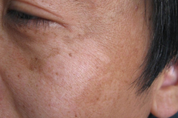 光老化面部皮肤颜色加深图