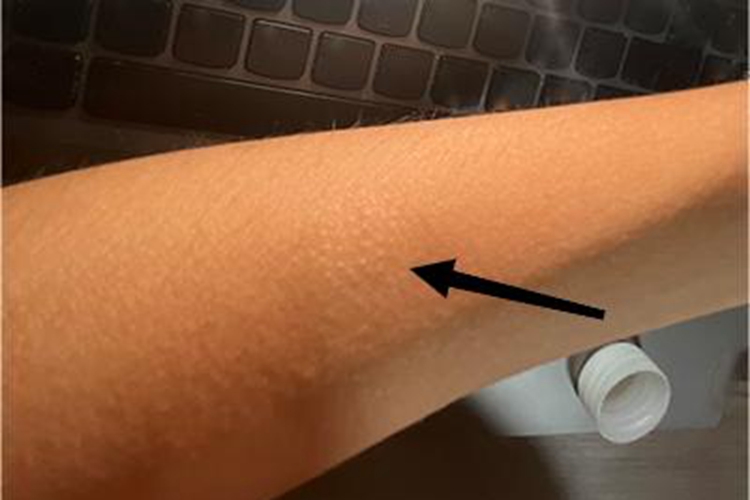 小棘苔藓胳膊症状图